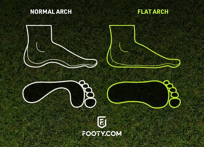 normal feet and flat feet comparison visual